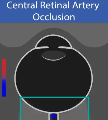 انسداد شریان شبکیه