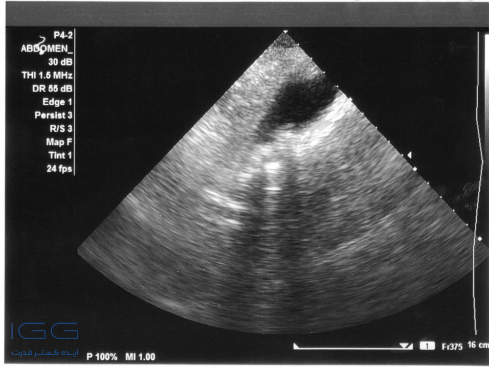 تشخیص سنگ صفرا با سونوگرافی