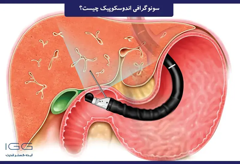 اندوسکوپیک