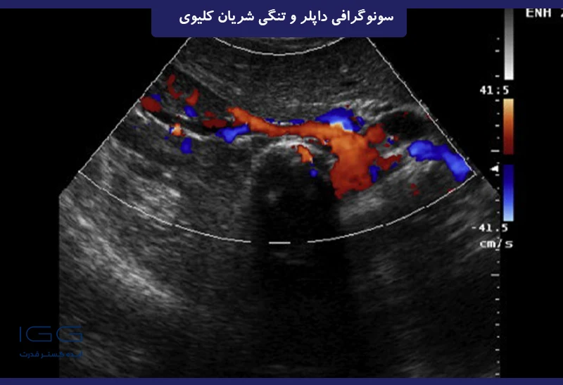 تصویر رنگی داپلر سونوگرافی از کلیه راست با عروق کلیوی