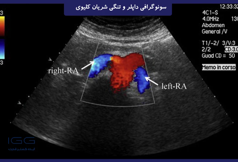 سونوگرافی داپلر و تنگی شریان کلیوی