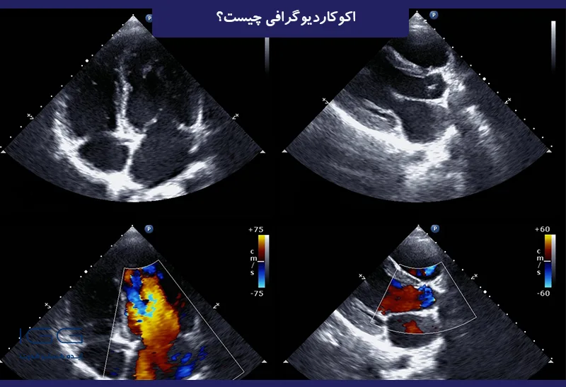 اکوکاردیوگرافی چیبست؟