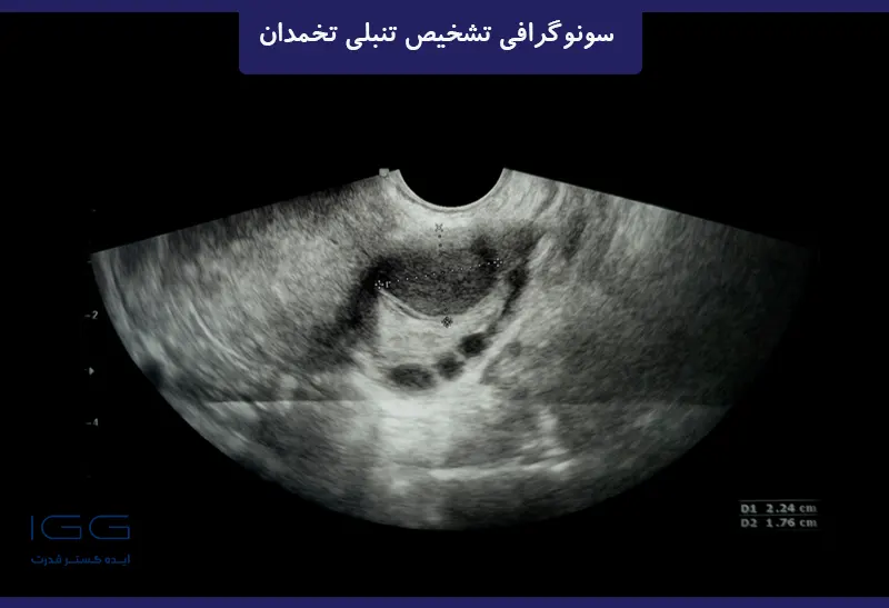 عکس سونوگرافی تخمدان برای تمبلی تخمدان