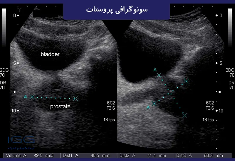 عکس سونوگرافی پروستات