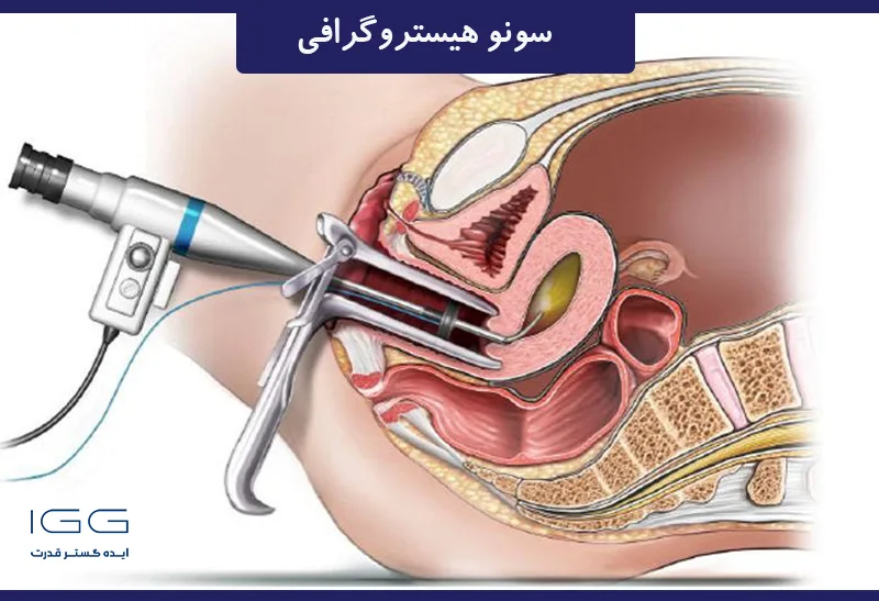 سونو هیستروگرافی نحوه انجام