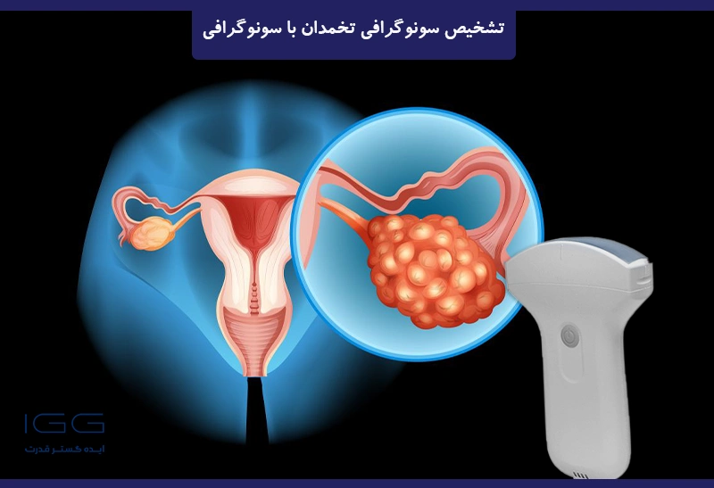 تشخیص سرطان تخمدان با سونوگرافی