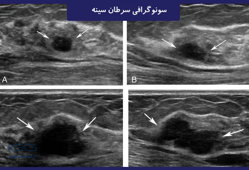 سونوگرافی سینه