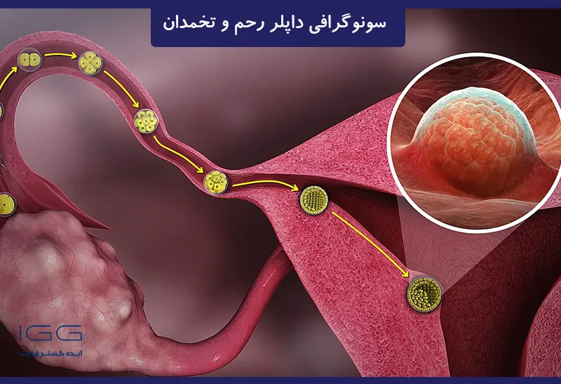 سونوگرافی داپلر رحم و تخمدان