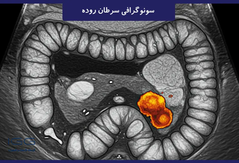 سونوگرافی سرطان روده