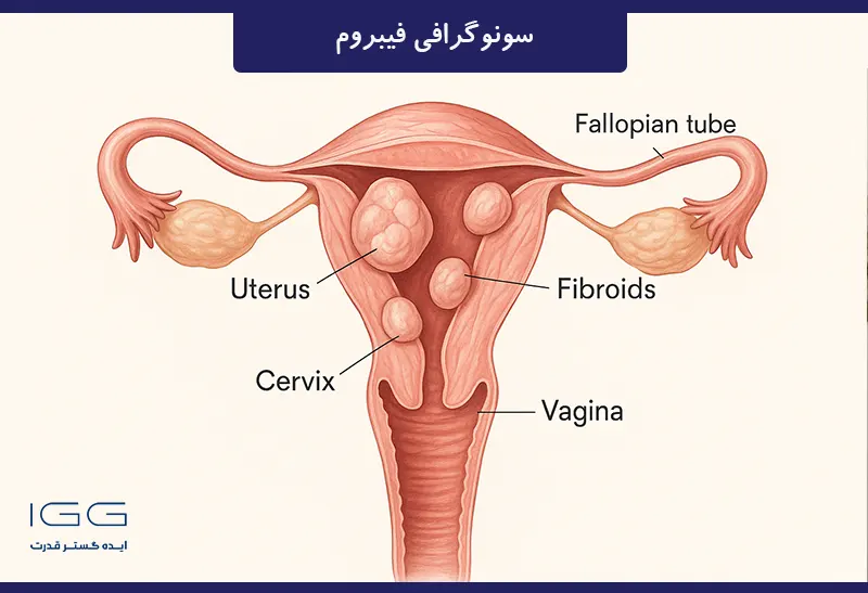 فیبروم آناتومی