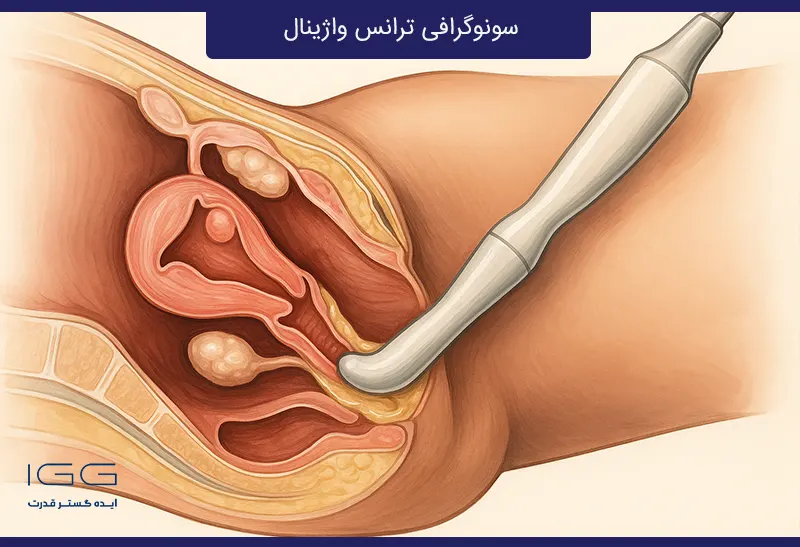 تفاوت سونوگرافی ترانس واژینال 