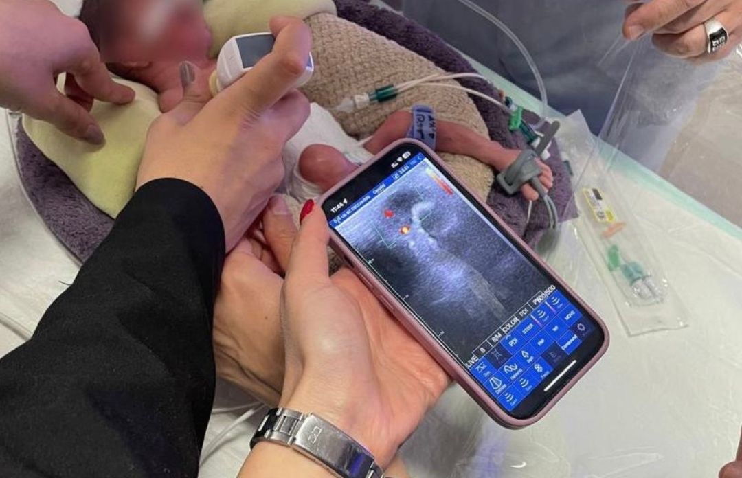 سونوگرافی نوزاد با دستگاه هندهلد SonoStar تصویربرداری سونوگرافی بر بالین نوزاد در NICU با پروب SonoStar متصل به موبایل و نمایش داپلر رنگی