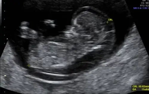جنین مبتلا به هیگرومای کیستیک و اندازه گیری طول crown–rump در سه ماهه اول