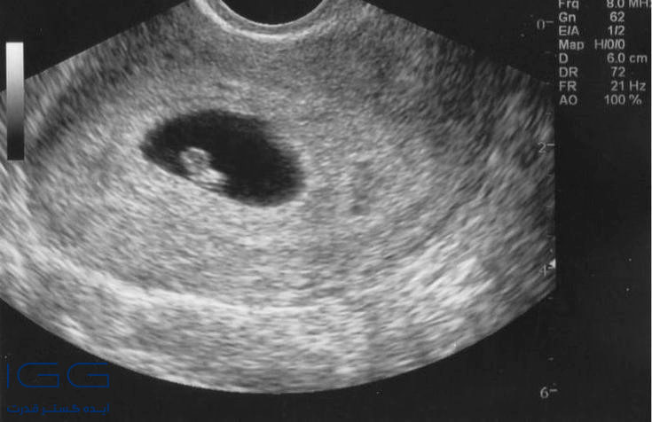 تفاوت جنین دختر و پسر در سونوگرافی